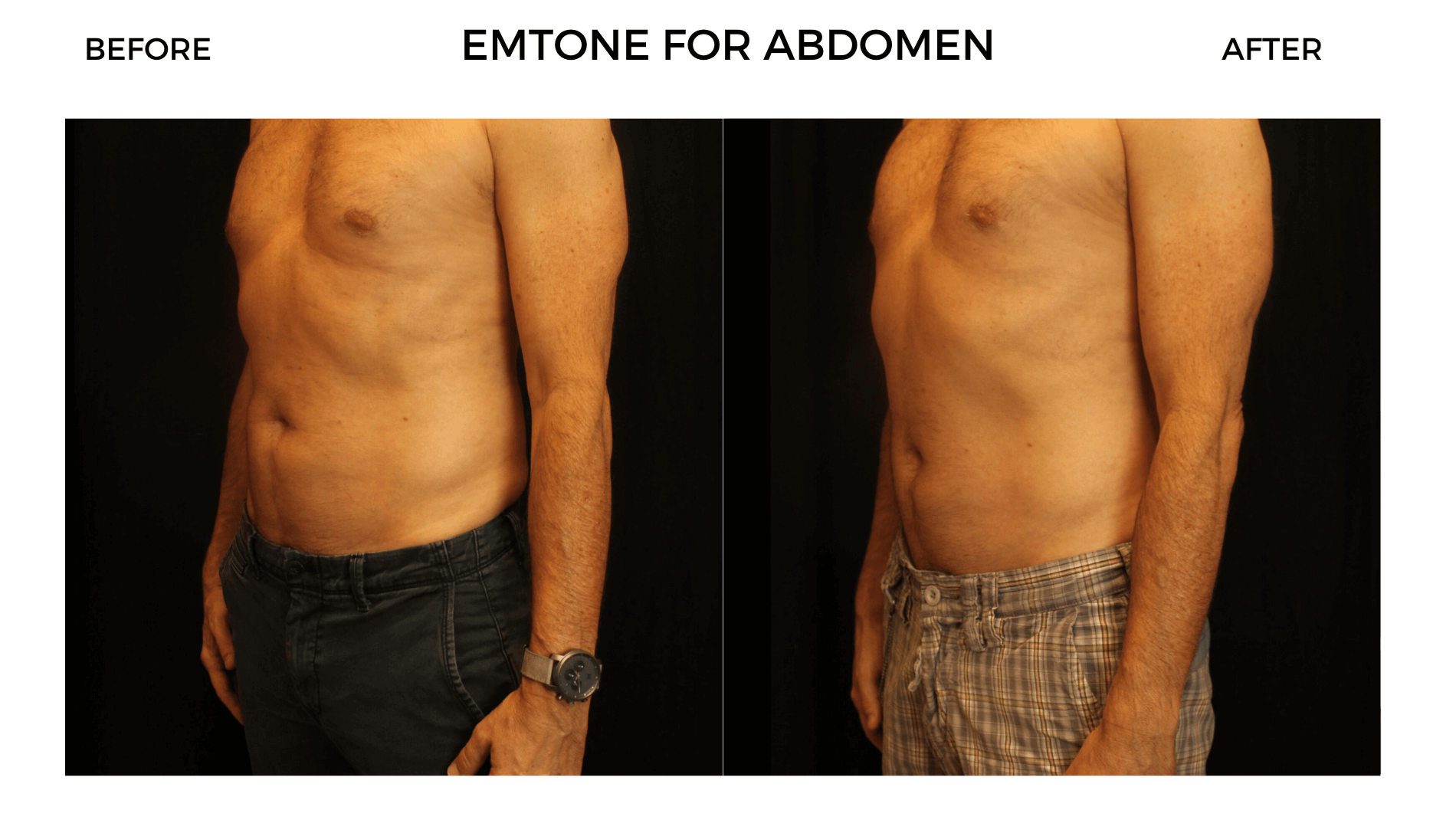 EMtone for Abs